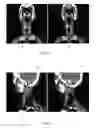 Fig. 05 - Image-guided radiotherapy for internal tumor boost