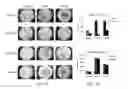 Fig. 03 - Genetic amplification of IQGAP1 in cancer