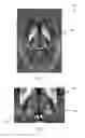 Fig. 02 - SYSTEM AND METHOD FOR LOCATING AND QUANTIFYING A BIOMARKER FOR NEUROLOGICAL DISEASE