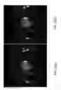 Fig. 11 - Compensated magnetic resonance imaging system and method for improved magnetic resonance imaging and diffusion imaging