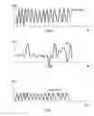 Fig. 03 - Estimating local motion of physical exercise