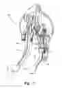 Fig. 07 - Two piece pedal arm