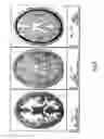 Fig. 10 - TARGETED ELECTRICAL STIMULATION