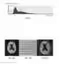 Fig. 03 - Method for volume evaluation of penumbra mismatch in acute ischemic stroke and system therefor