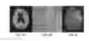 Fig. 04 - Method for volume evaluation of penumbra mismatch in acute ischemic stroke and system therefor