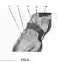 Fig. 03 - Shoe Lace Securing Device