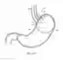 Fig. 69 - SYSTEMS AND METHODS FOR LOCATING AND/OR CHARACTERIZING INTRAGASTRIC DEVICES