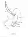 Fig. 74 - SYSTEMS AND METHODS FOR LOCATING AND/OR CHARACTERIZING INTRAGASTRIC DEVICES