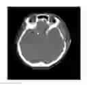 Fig. 01 - Method for densitometric analysis of computed tomography image