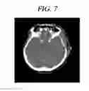 Fig. 08 - Method for densitometric analysis of computed tomography image