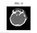 Fig. 12 - Method for densitometric analysis of computed tomography image
