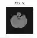 Fig. 15 - Method for densitometric analysis of computed tomography image