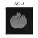 Fig. 16 - Method for densitometric analysis of computed tomography image