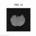 Fig. 17 - Method for densitometric analysis of computed tomography image