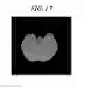 Fig. 18 - Method for densitometric analysis of computed tomography image