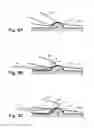 Fig. 05 - Apparatus for safely and accurately excising core tissue samples from palpated nodules or surface lesions