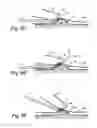 Fig. 06 - Apparatus for safely and accurately excising core tissue samples from palpated nodules or surface lesions