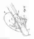 Fig. 10 - METHODS AND APPARATUS FOR SECURING MEDICAL INSTRUMENTS TO DESIRED LOCATIONS IN A PATIENT'S BODY