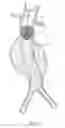 Fig. 03 - Catheter based fastener implantation apparatus and methods