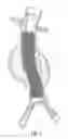 Fig. 04 - Catheter based fastener implantation apparatus and methods