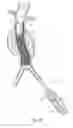 Fig. 11 - Catheter based fastener implantation apparatus and methods
