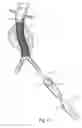 Fig. 17 - Catheter based fastener implantation apparatus and methods