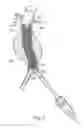 Fig. 30 - Catheter based fastener implantation apparatus and methods