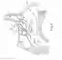Fig. 05 - Method and apparatus for forming opening in a sinus wall