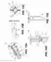 Fig. 16 - Compact endoscopic surgical blade assembly and method of use thereof