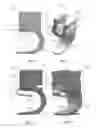 Fig. 04 - Stabilized spinal fixation device