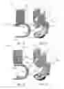 Fig. 09 - Stabilized spinal fixation device