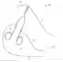 Fig. 01 - INTEGRATED SUTURE AND CAUTERIZATION