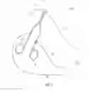Fig. 03 - INTEGRATED SUTURE AND CAUTERIZATION