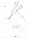Fig. 04 - INTEGRATED SUTURE AND CAUTERIZATION