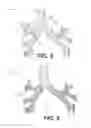 Fig. 05 - DEVICES FOR DAMAGING NERVES AND RELATED METHODS OF USE