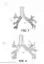 Fig. 06 - DEVICES FOR DAMAGING NERVES AND RELATED METHODS OF USE