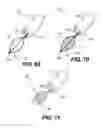 Fig. 32 - DEVICES FOR DAMAGING NERVES AND RELATED METHODS OF USE