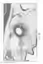 Fig. 04 - METHODS FOR MODULATING RENAL NERVE TISSUE AND ASSOCIATED SYSTEMS AND DEVICES