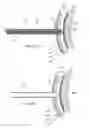 Fig. 06 - Electrosurgical pericardial puncture