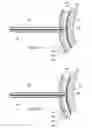 Fig. 09 - Electrosurgical pericardial puncture
