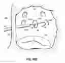 Fig. 20 - Systems and methods for treating the heart with ablation