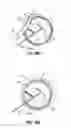 Fig. 22 - Systems and methods for treating the heart with ablation