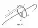 Fig. 34 - Systems and methods for treating the heart with ablation