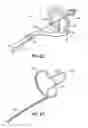 Fig. 35 - Systems and methods for treating the heart with ablation