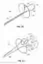 Fig. 37 - Systems and methods for treating the heart with ablation