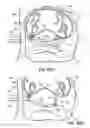Fig. 40 - Systems and methods for treating the heart with ablation