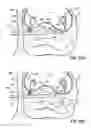 Fig. 43 - Systems and methods for treating the heart with ablation