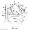 Fig. 46 - Systems and methods for treating the heart with ablation