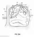 Fig. 47 - Systems and methods for treating the heart with ablation
