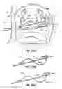 Fig. 48 - Systems and methods for treating the heart with ablation